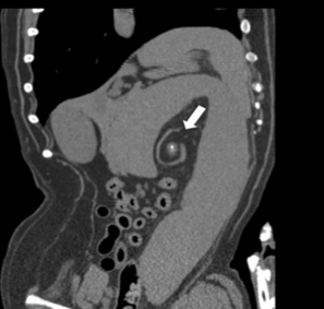 Figura 3. – Imagem de tomografia computadorizada de um cão, projeção oblíqua dorsal, pré-contraste no plano transversal de um centro hiperatenuante para um típico sinal de turbilhão (seta branca). Fonte: Hughes et al. (2020).