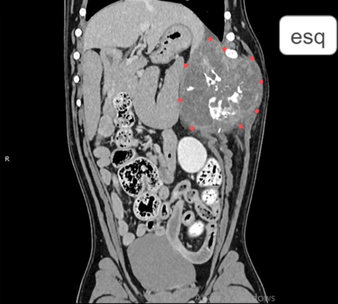 Tomografia computadorizada da paciente. Os pontos vermelhos indicam os limites da massa envolvendo os arcos costais e deslocando os órgãos abdominais (lobos hepáticos da divisão esquerda, baço e estômago).